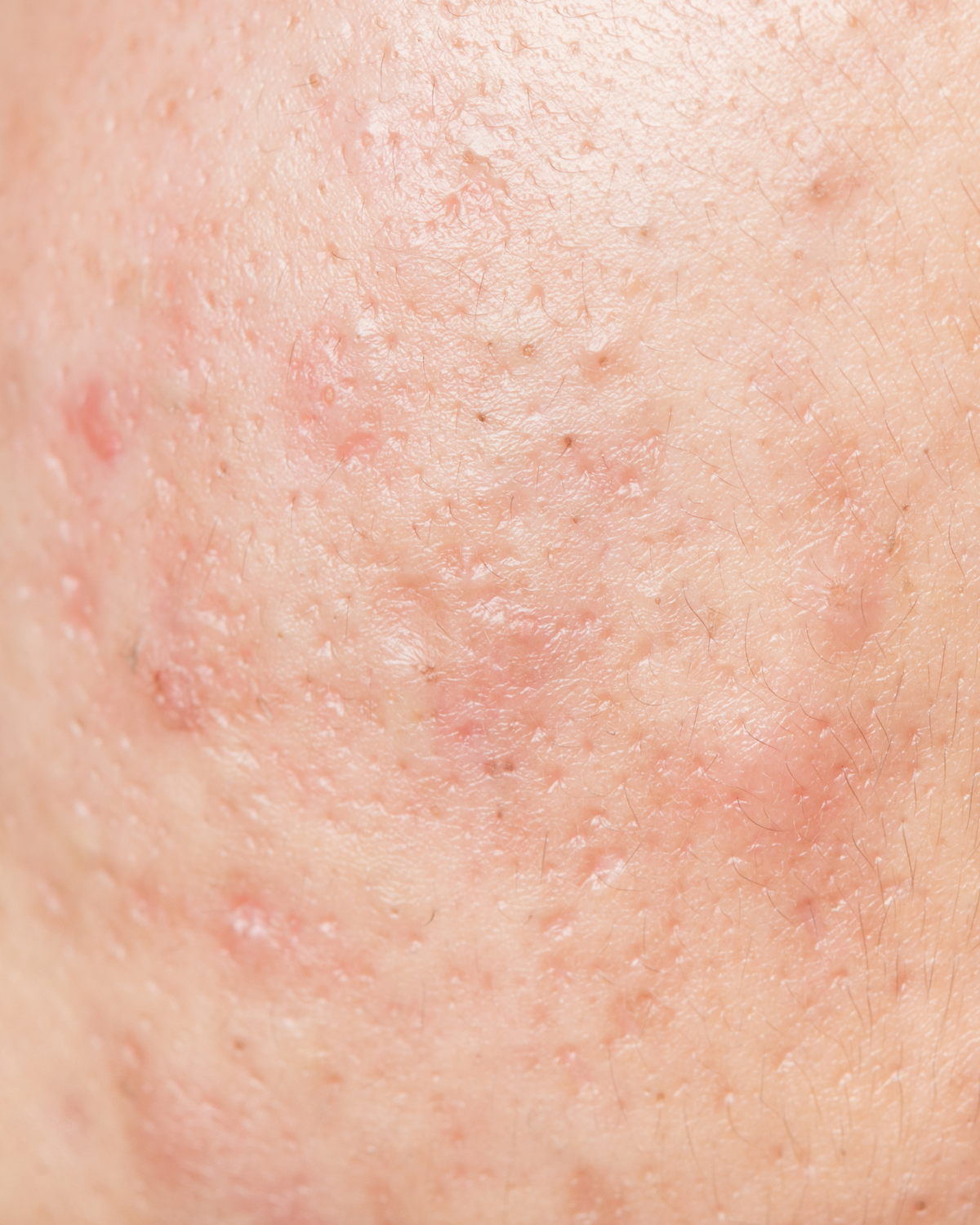 Acne-prone skin