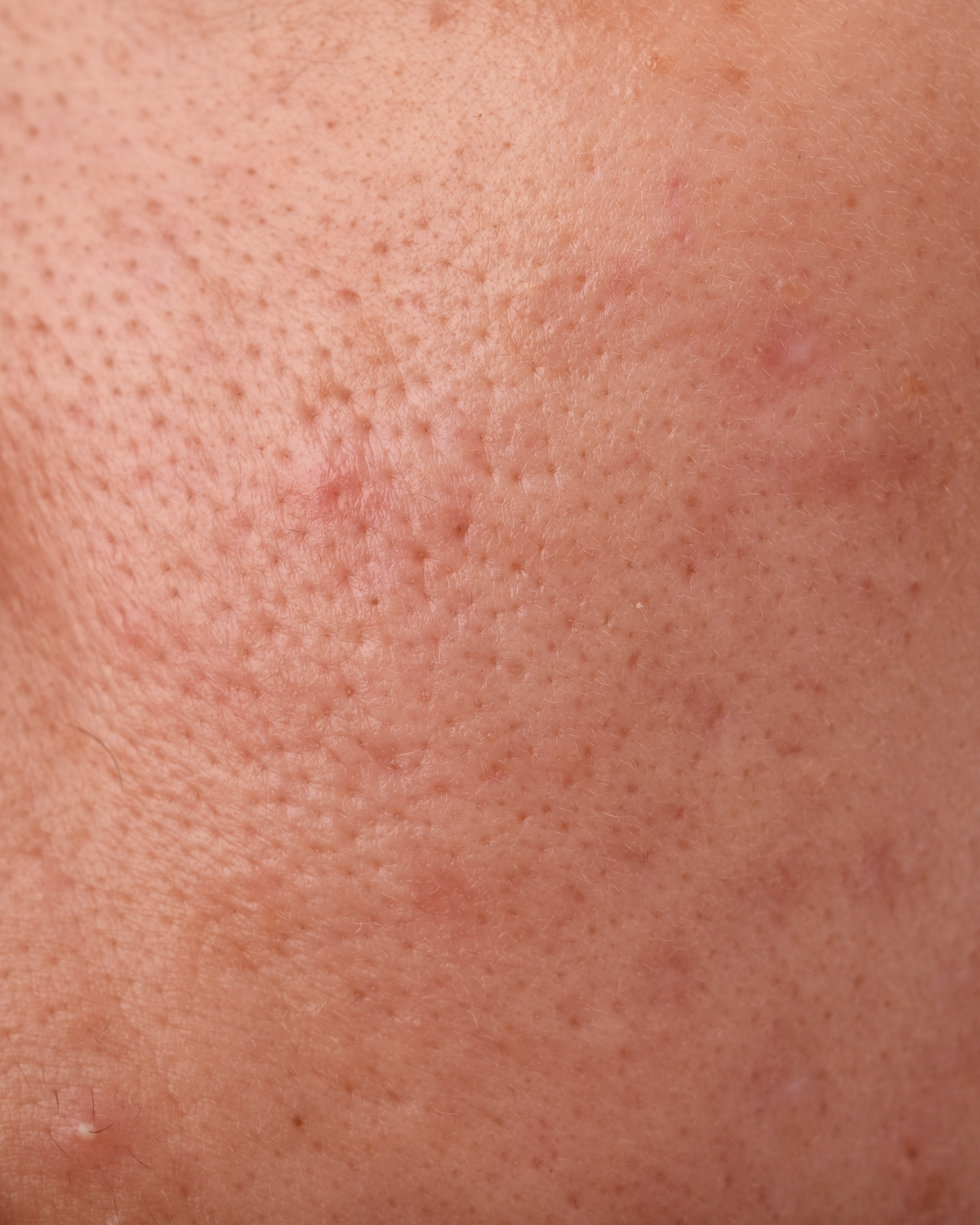 Combination skin