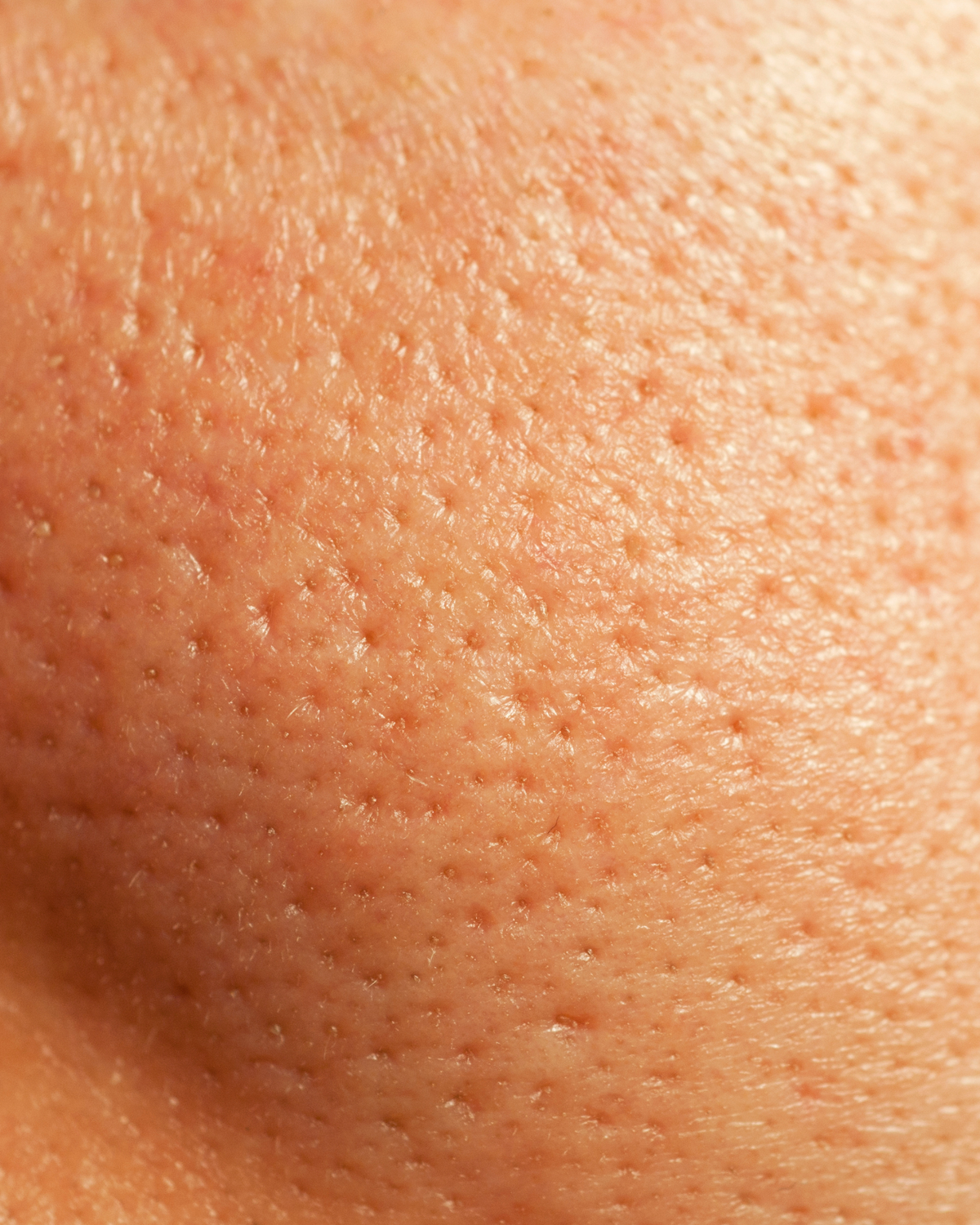 Oily skin