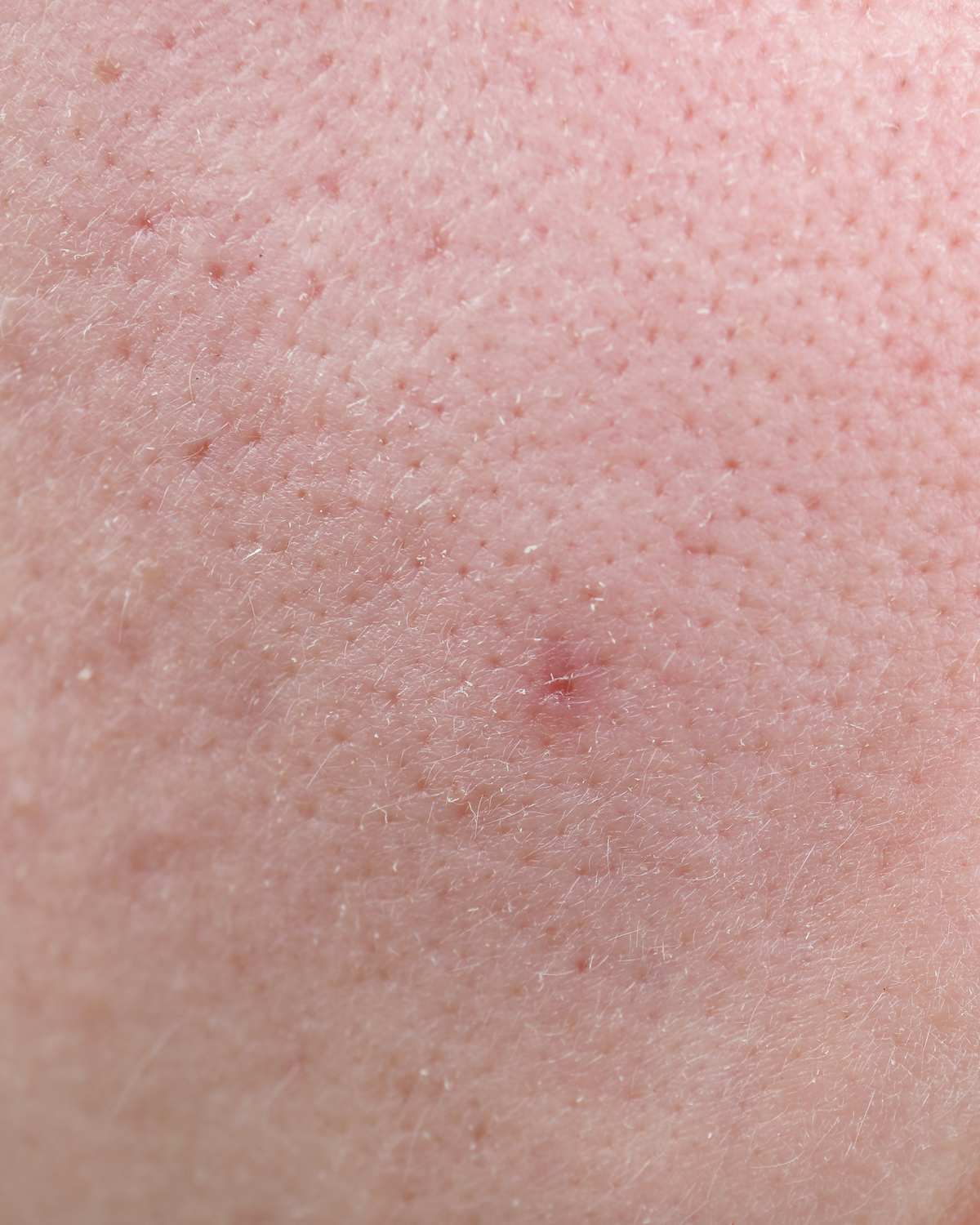 Sensitive skin