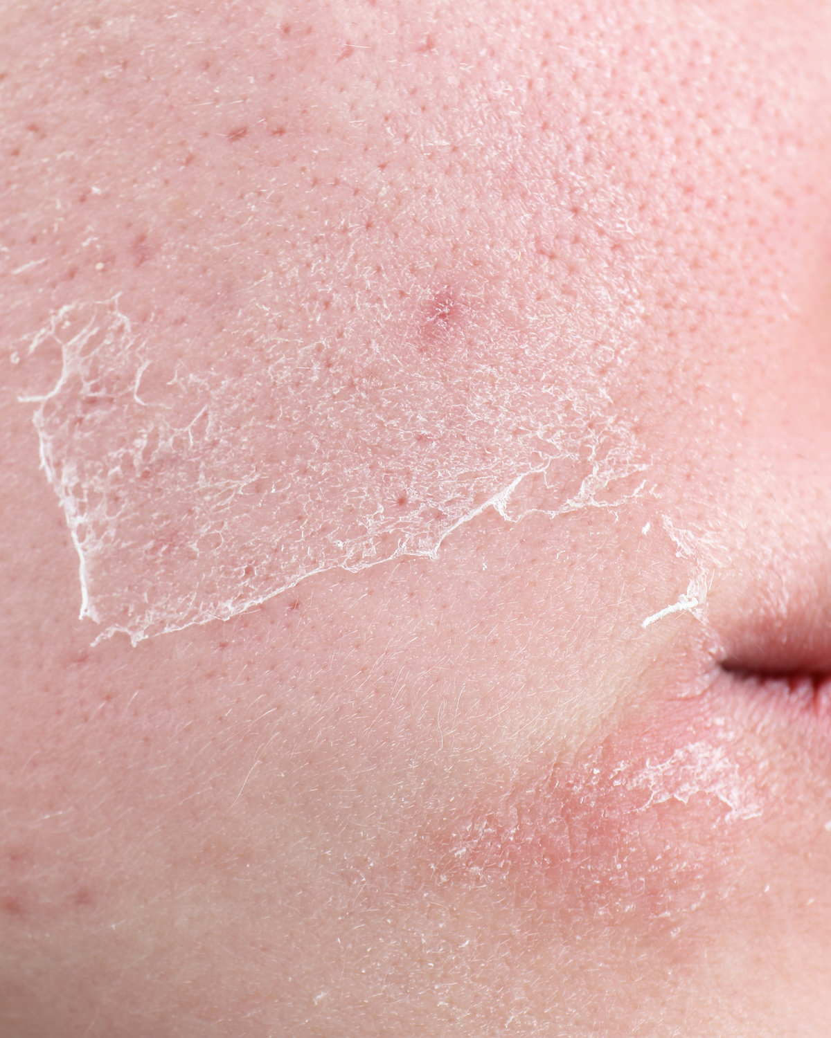 Dry skin